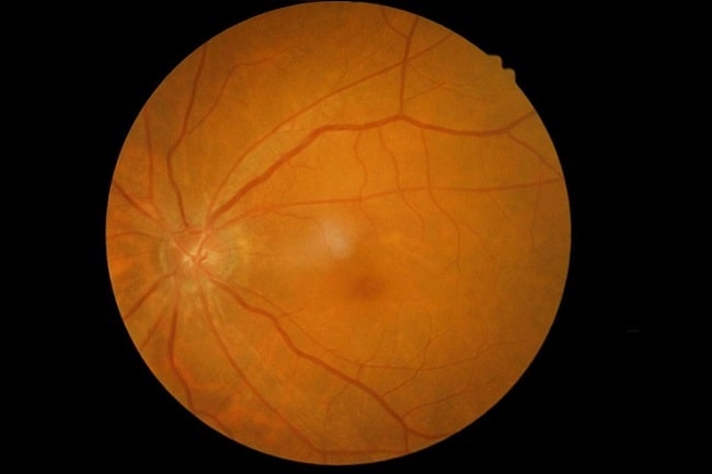 Fundus Retinal Photography