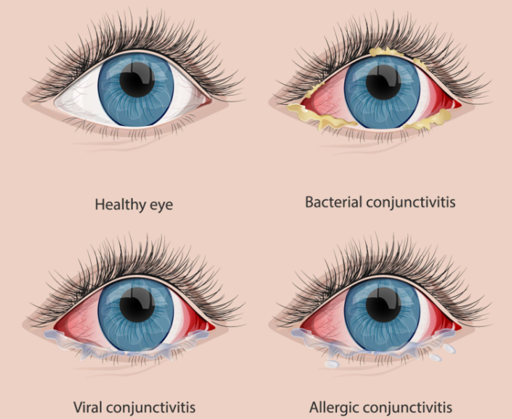 pink eye causes